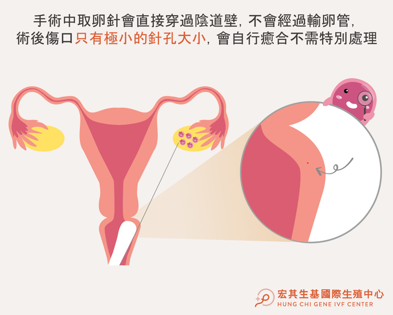 取卵步驟 - 宏生_5